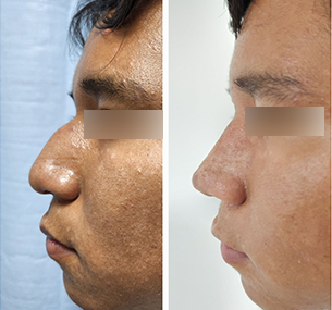 Resultado de rinoplastia en Cuernavaca - Dr. Mariano Castillo