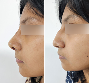 Resultado de rinoplastía en Cuernavaca Dr. Mariano Castillo