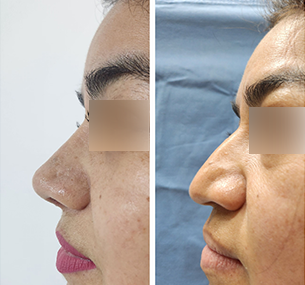 Antes y después rinoplastía en Cuernavaca Dr. Mariano Castillo