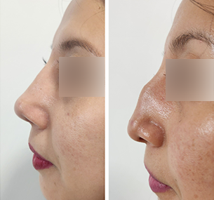 Resultado de rinoplastia en Cuernavaca, Dr. Mariano Castillo