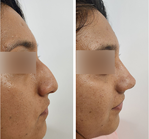 Dr Mariano Castillo antes y después rinoplastia